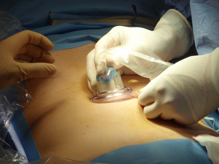 El paciente, al que se le ha extirpado un tumor en el colon, es un varón de 59 años