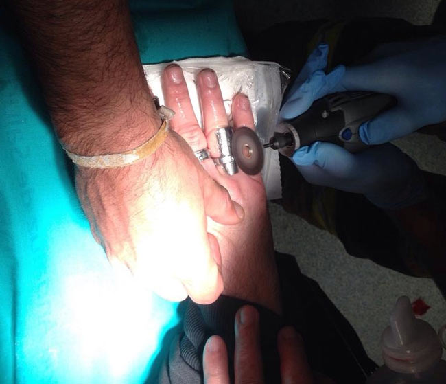 bomberos-de-sevilla-quitna-anillo-atrapado