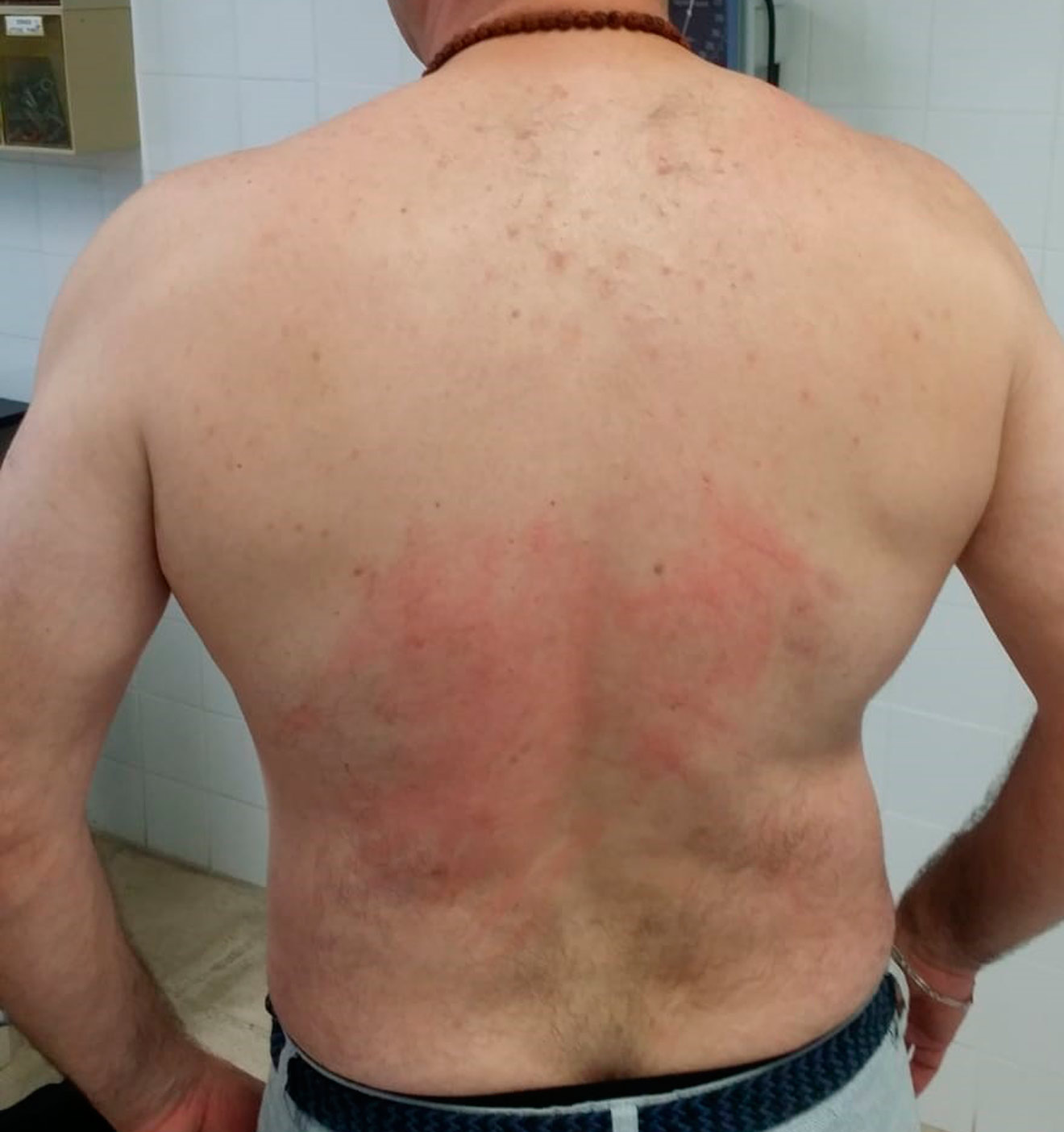 Espalda lesionada /Colega Torremolinos