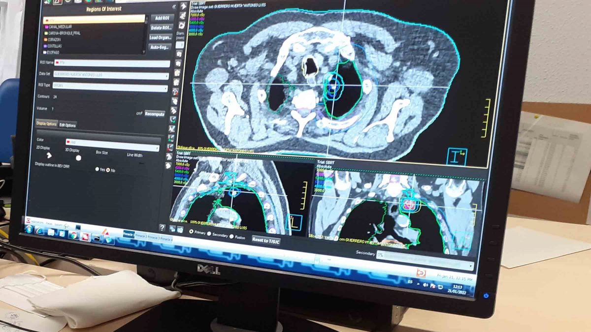 Imagen de la detección de un tumor