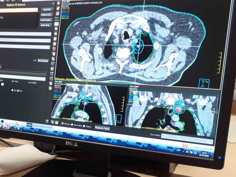 Imagen de la detección de un tumor