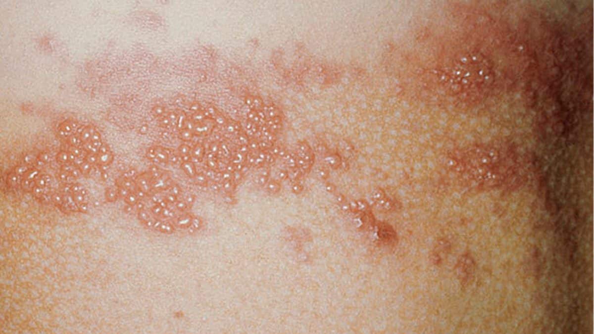Herpes zóster síntomas