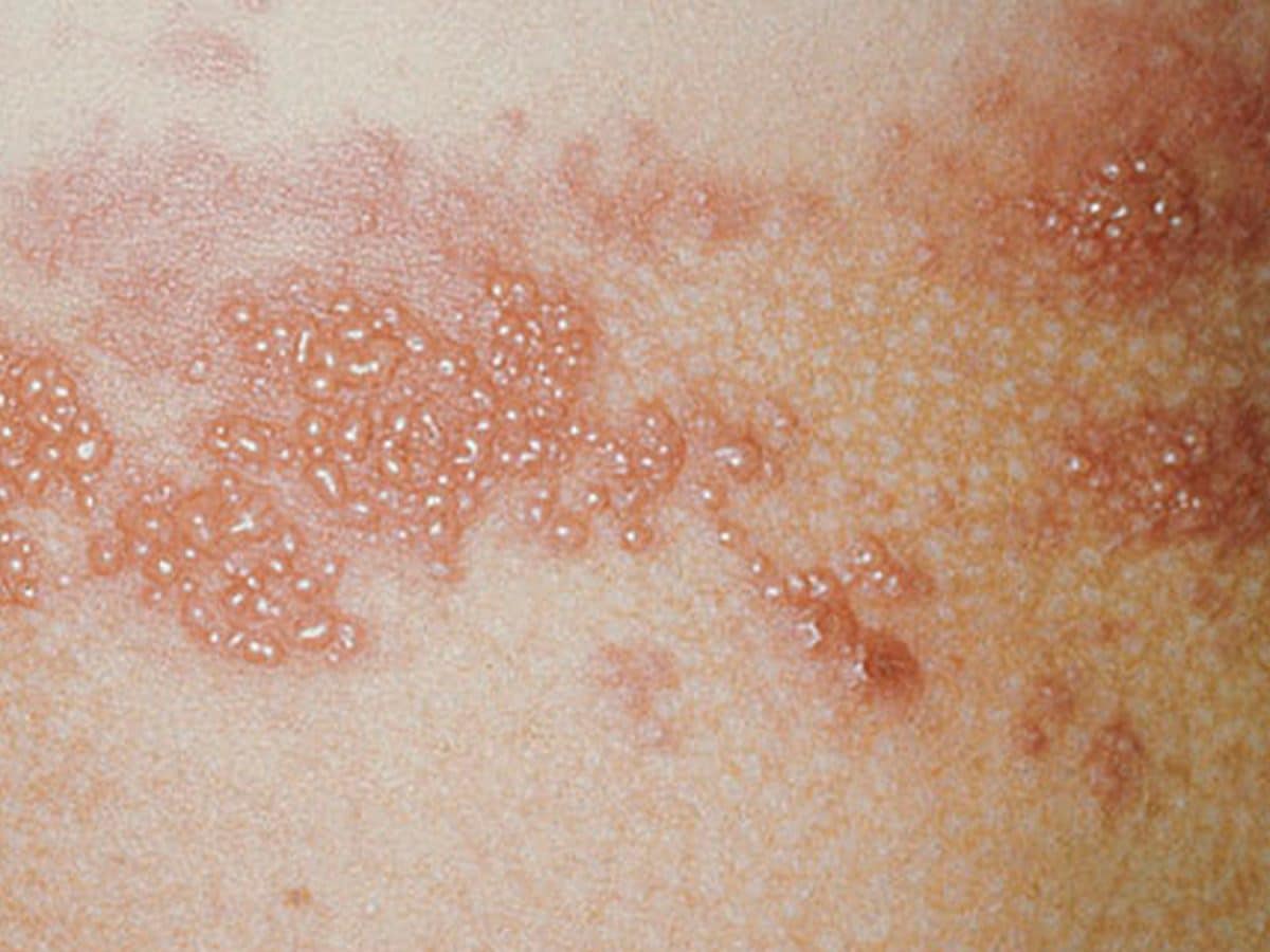 Herpes zóster síntomas