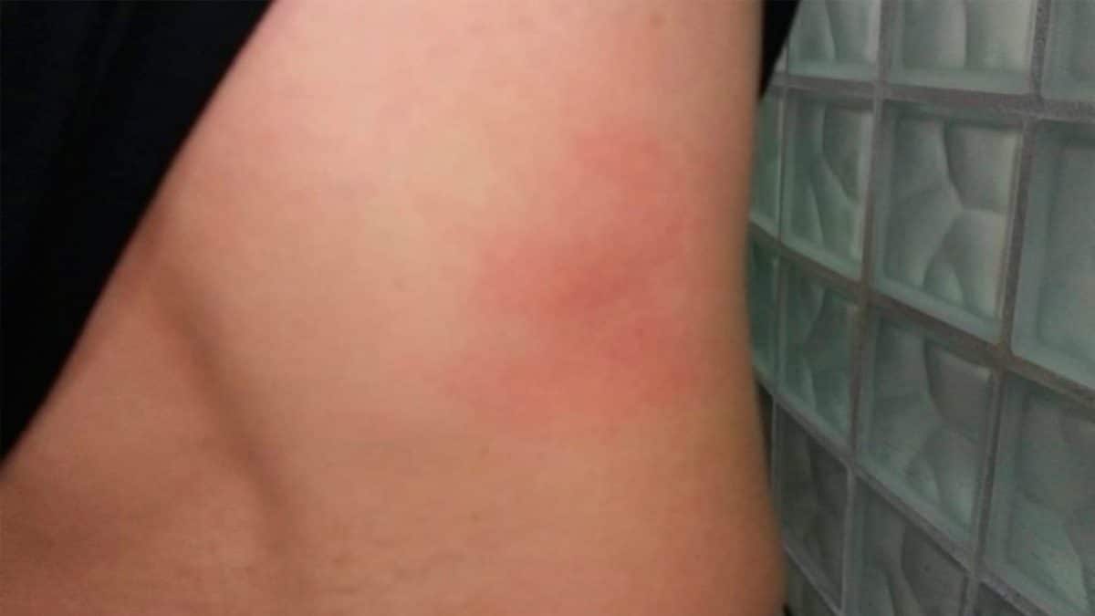 Fotografía de un golpe ocasionado durante las supuestas torturas por parte de dos agentes de policía en Guillena, suceso investigado por el Defensor del Pueblo