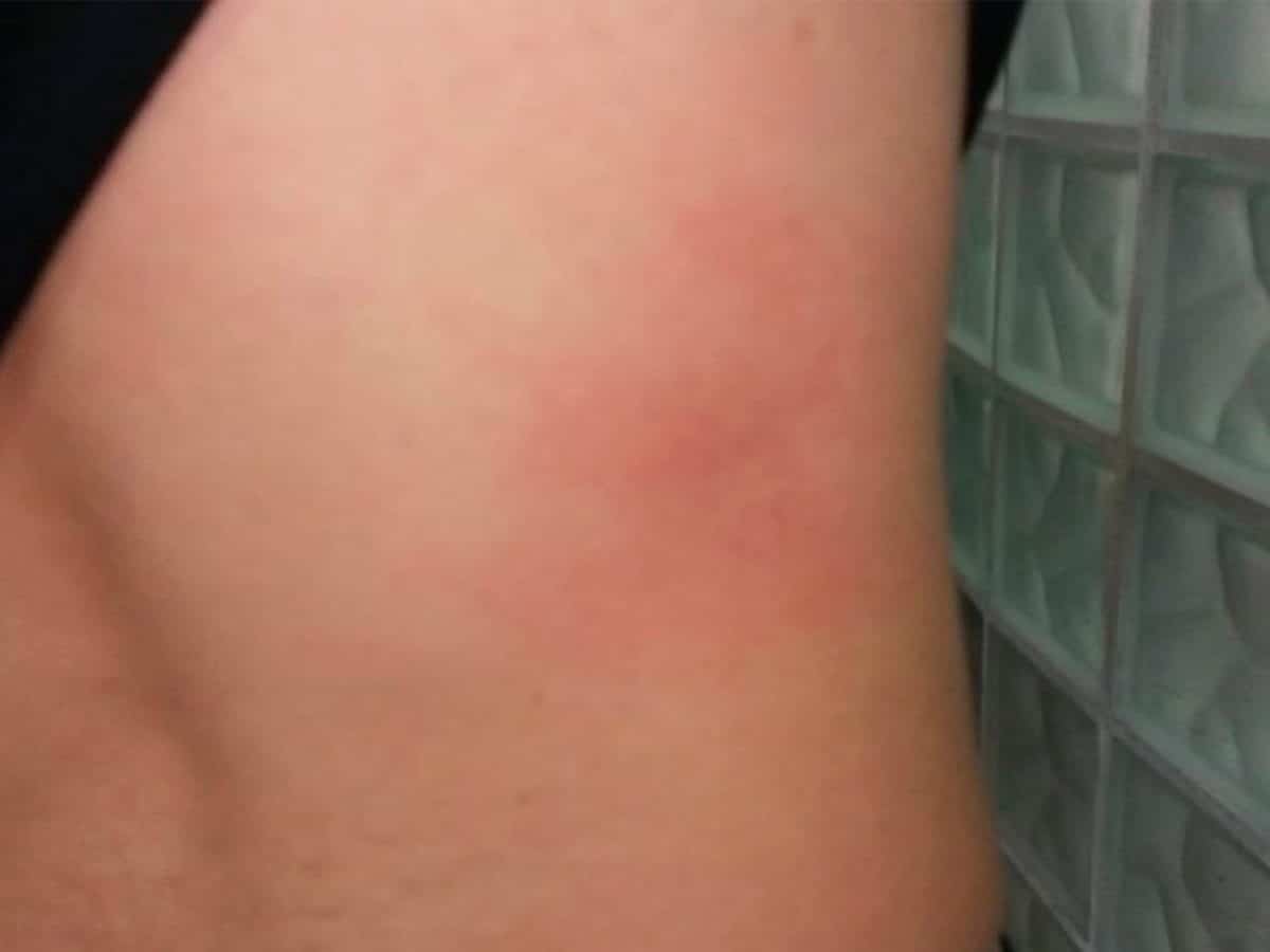 Fotografía de un golpe ocasionado durante las supuestas torturas por parte de dos agentes de policía en Guillena, suceso investigado por el Defensor del Pueblo