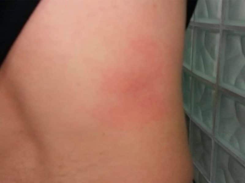 Fotografía de un golpe ocasionado durante las supuestas torturas por parte de dos agentes de policía en Guillena, suceso investigado por el Defensor del Pueblo