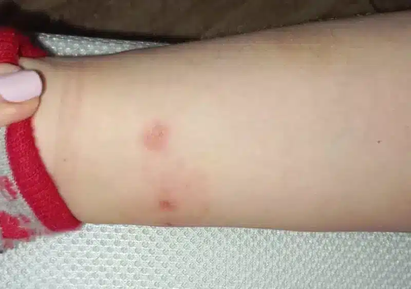 Imagen de las picaduras de uno de los alumnos por la situación del arenero - AMPA DEL CEIP AL-ÁNDALUS