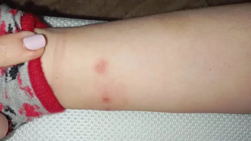 Imagen de las picaduras de uno de los alumnos por la situación del arenero - AMPA DEL CEIP AL-ÁNDALUS