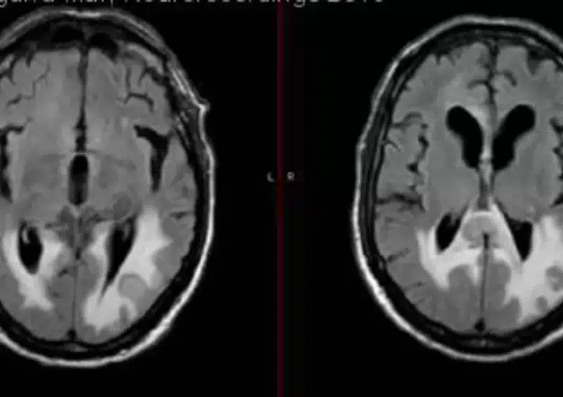 Imagen de un paciente con linfoma cerebral