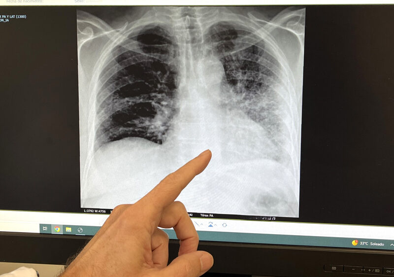 Foto RX de un paciente fumador con cáncer de pulmón. - QuirónSalud